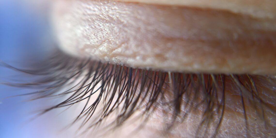 Powieki z problemami